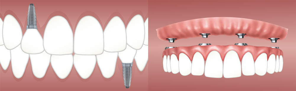 Implantes Dentales